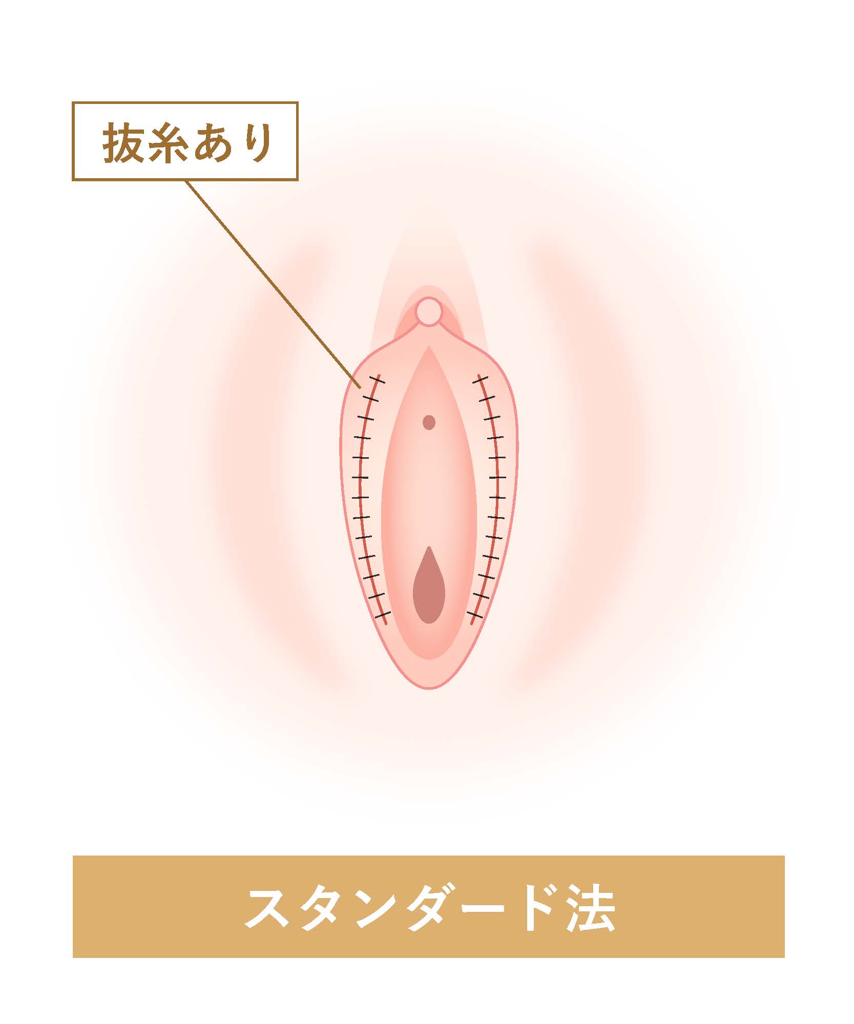 スタンダード法  抜糸あり