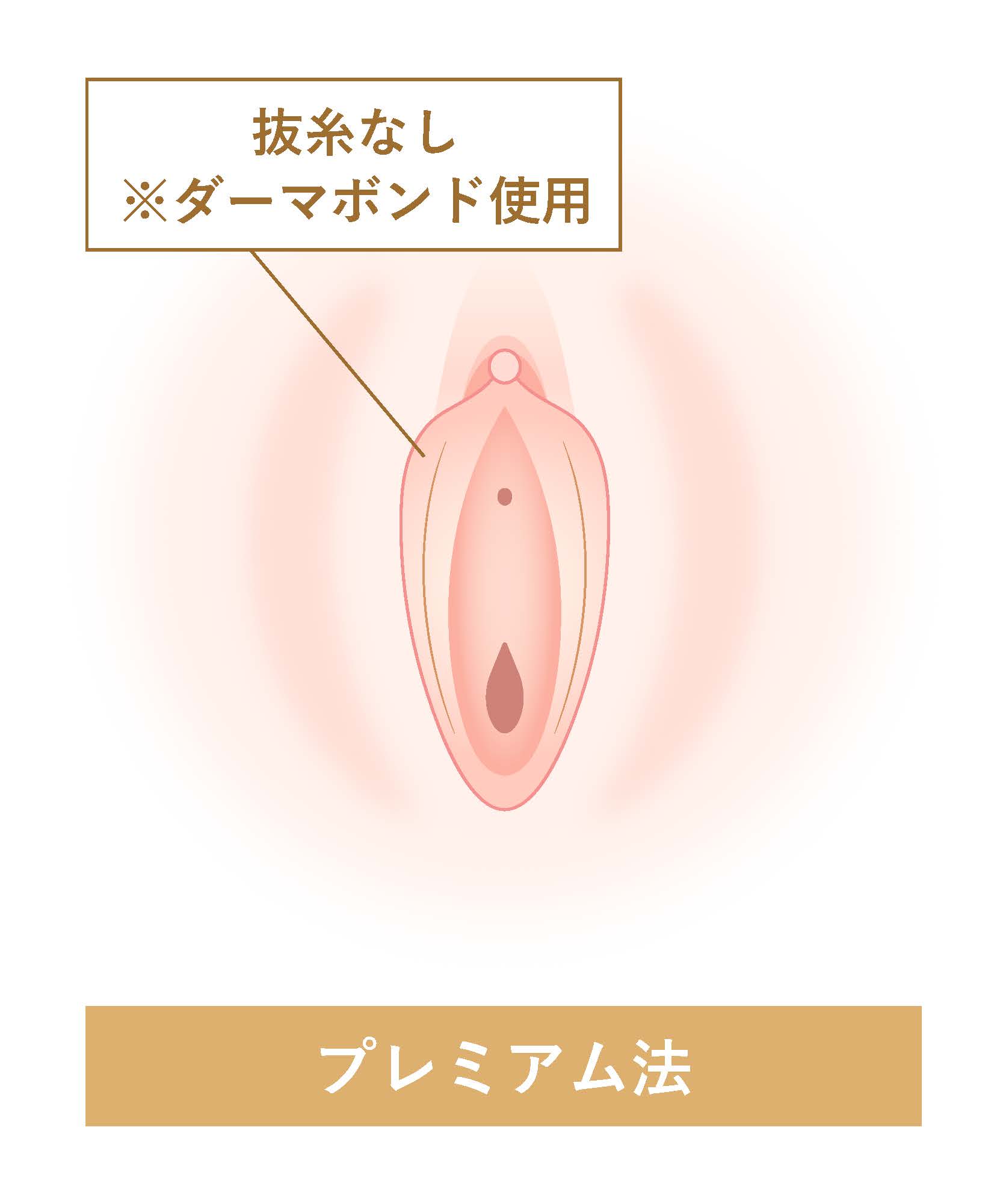 プレミアム法  抜糸なし※ダーマボンド使用
