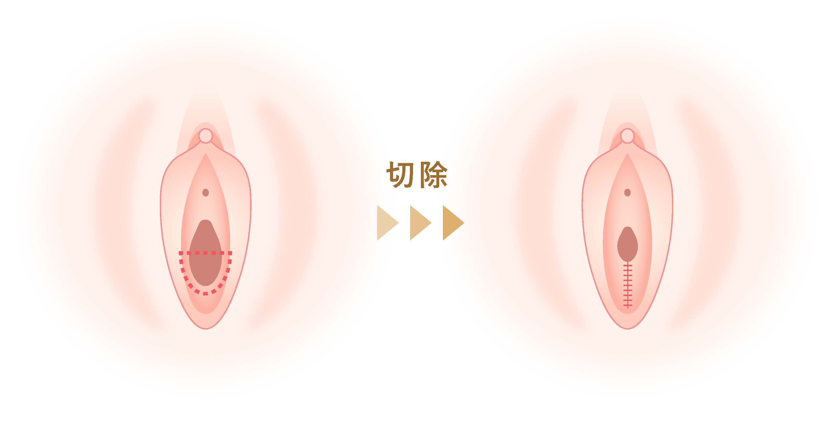 腟壁縮小のイラスト